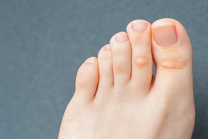 Corns and Calluses The Causes and Cures